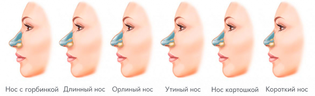 типы носов у людей схема